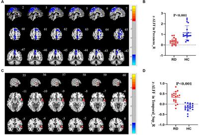 Altered functional activity of the precuneus and superior temporal gyrus in patients with residual dizziness caused by benign paroxysmal positional vertigo